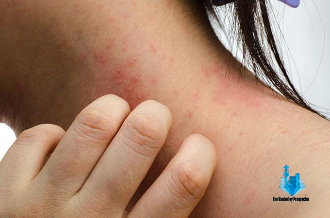 Kimberley Resident Develops Chest Rash After Exposure to Smouldering Dumpster Fire